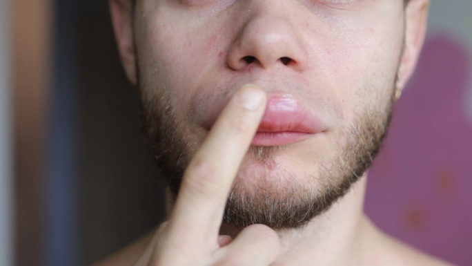 唇肿伴过敏反应，血管水肿过敏药膏。