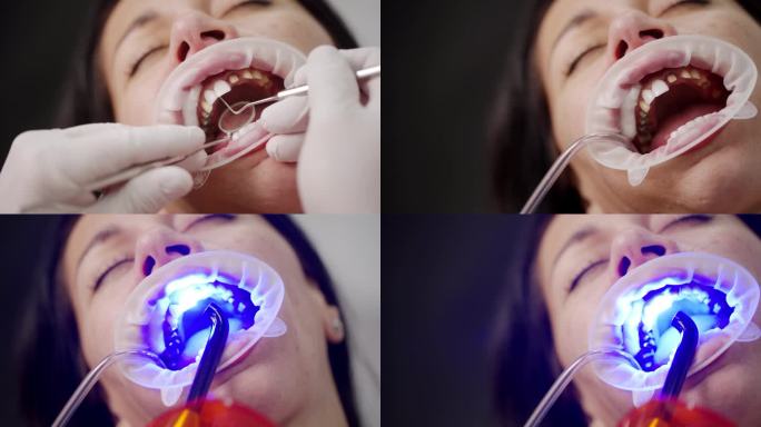 安装氧化锆单板的过程。牙科诊所里，牙医用手用紫外光为女性牙齿粘接饰面和瓷冠。用紫外线灯粘接单板。特写