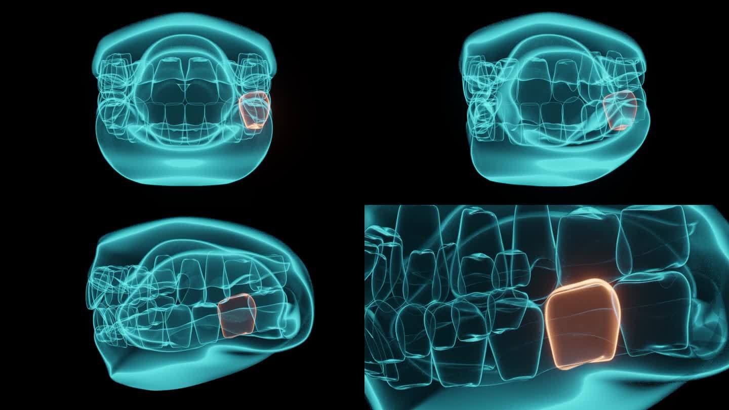 牙痛或牙齿感染。全息3d渲染动画。
