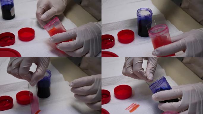 在实验室里，玻璃片上的血液涂片用特殊的染料染色。在实验室里，准备一张血液涂片，在显微镜下计算形成的元
