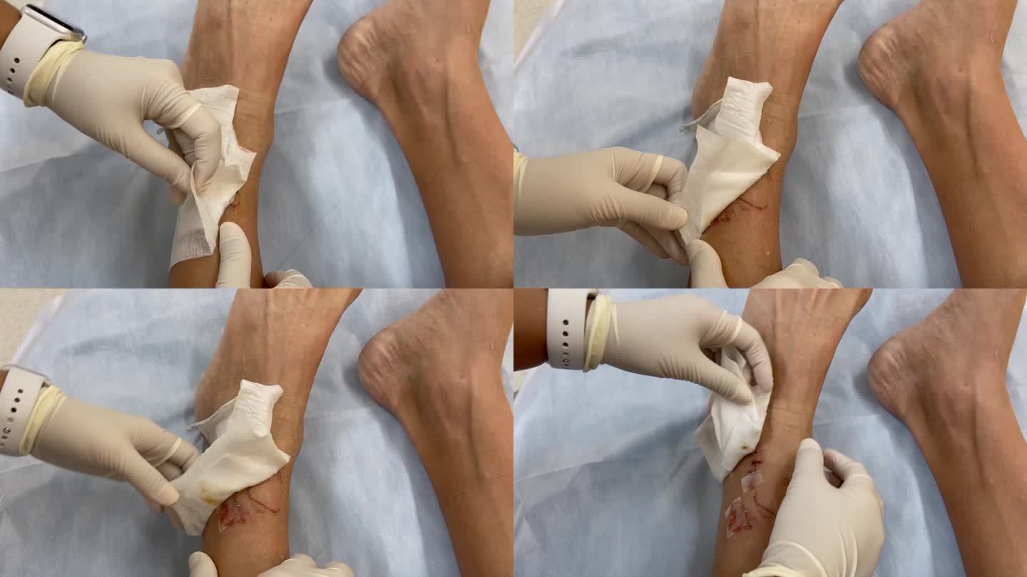 护士揭开病人脚踝上的绷带，露出伤口