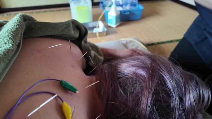 女治疗师从一位妇女背部的针灸针上取出电夹