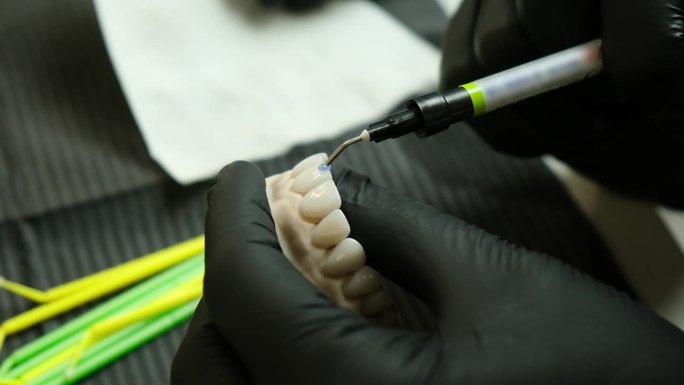 液体围堰在牙科诊所陶瓷贴面上的应用。