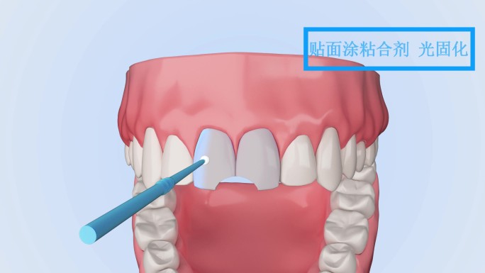 牙齿修复牙齿贴面