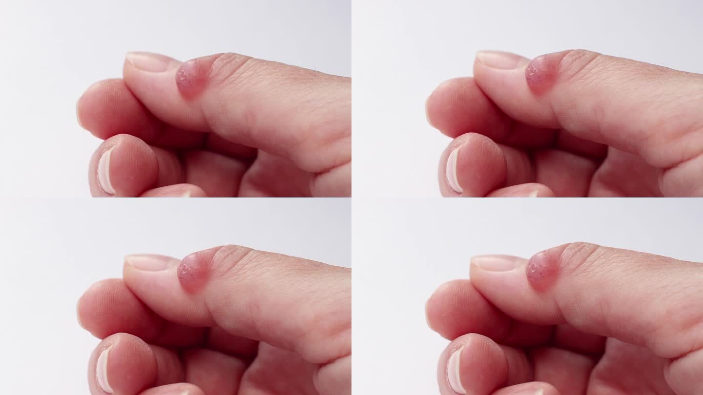 神经节囊肿(滑膜囊肿病)在一个女人的拇指