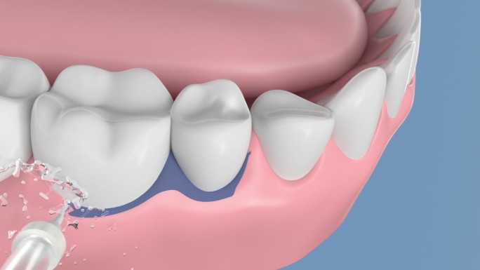 高清三维渲染冲牙器水冲牙齿牙垢