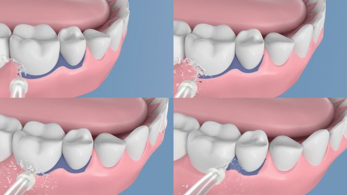 高清三维渲染冲牙器水冲牙齿牙垢