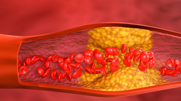 高脂血症。动脉阻塞的概念和人体血管作为一种疾病与胆固醇脂肪堆积堵塞。动脉阻塞，动脉中的胆固醇斑块。三