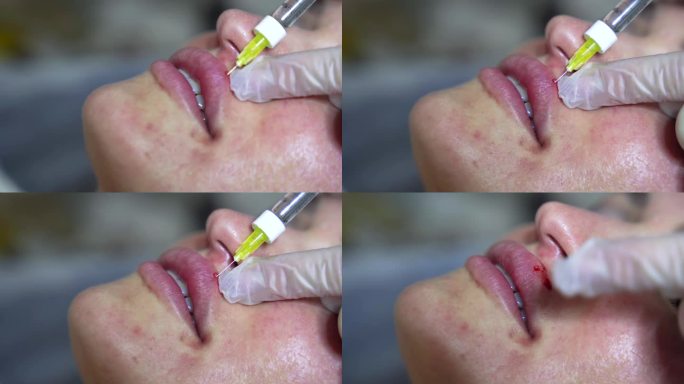 美容师医生在年轻美女的嘴唇上注射肉毒杆菌。极致的近距离4k拍摄