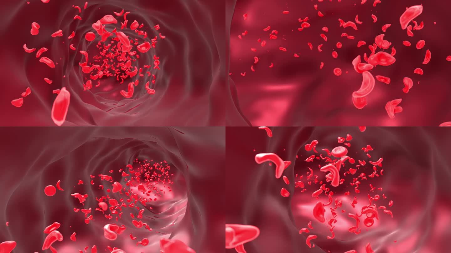 血管镰状细胞性贫血