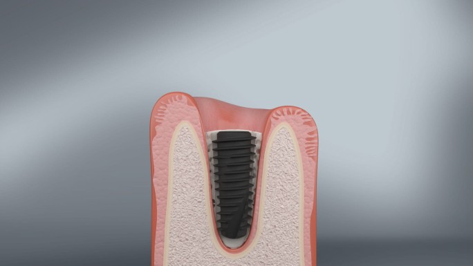 种植牙技术 植体植入牙齿  加大接触面积