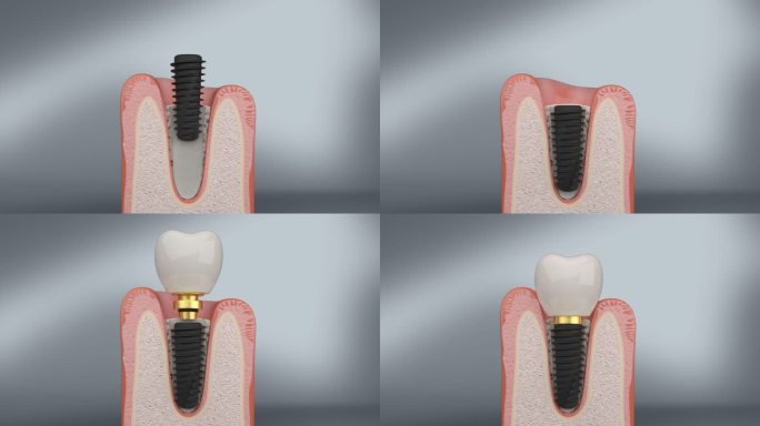 种植牙技术 植体植入牙齿  加大接触面积