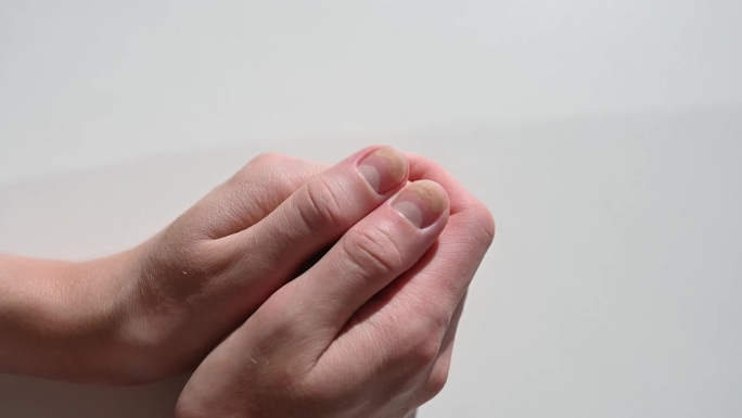 有指甲病变的手——骨髓炎，白色背景。美甲后甲板与甲床的分离