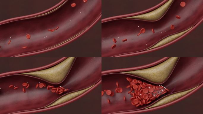胆固醇斑块阻塞了红细胞