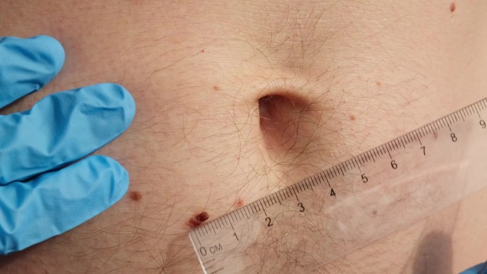皮肤科医生用尺子检查男性胎记。医生正在检查男性皮肤上良性痣的长度和宽度