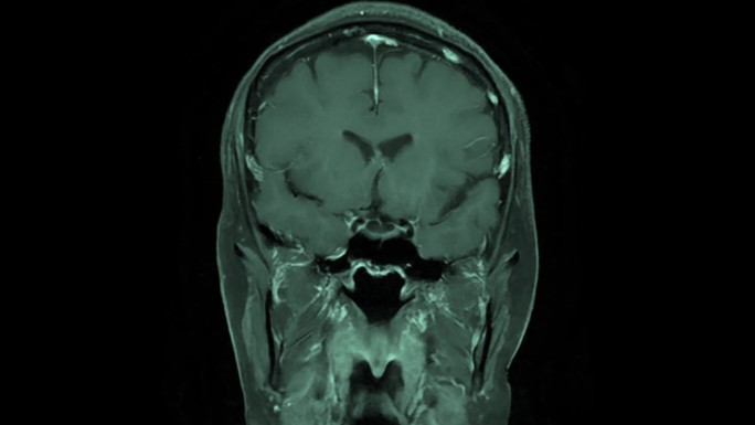 磁共振成像(MRI)