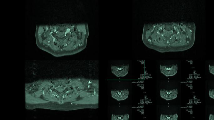 磁共振成像(MRI)