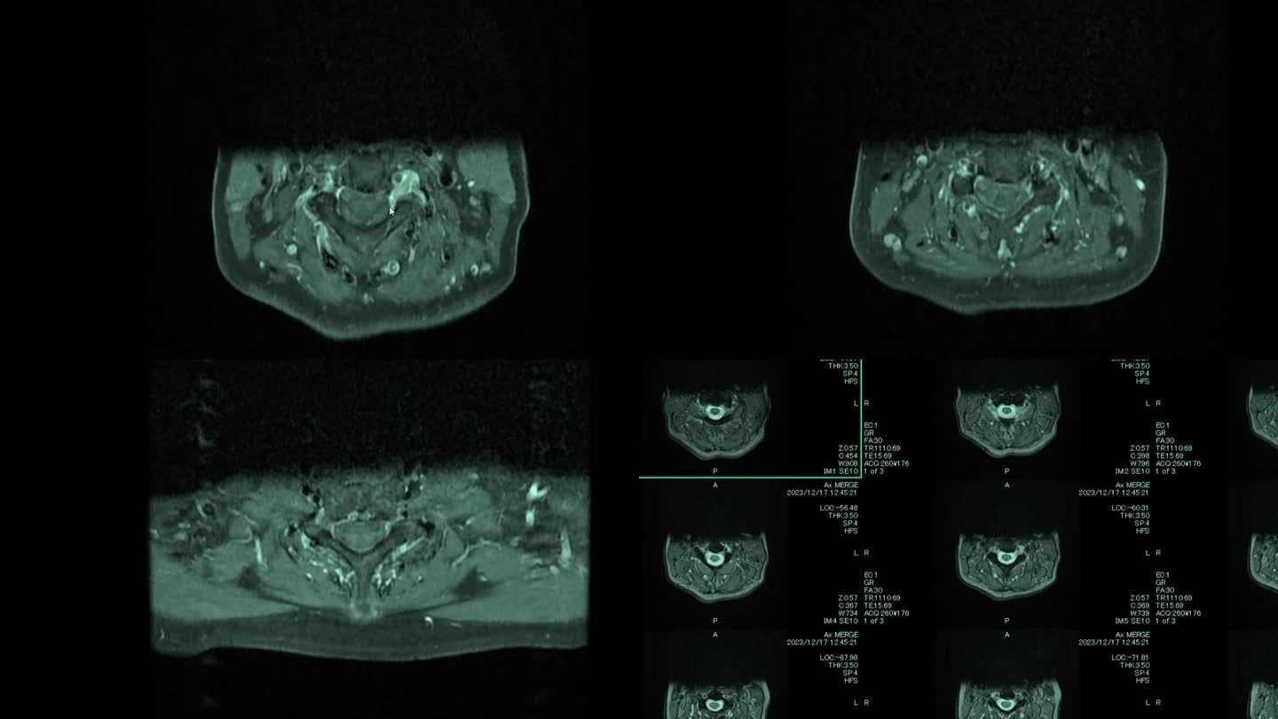 磁共振成像(MRI)