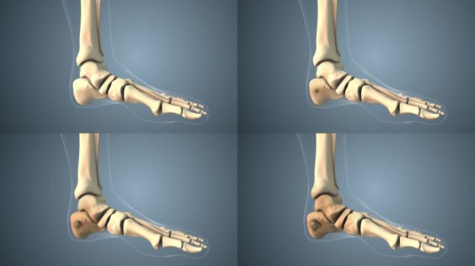 癌细胞沿着脚趾骨扩散