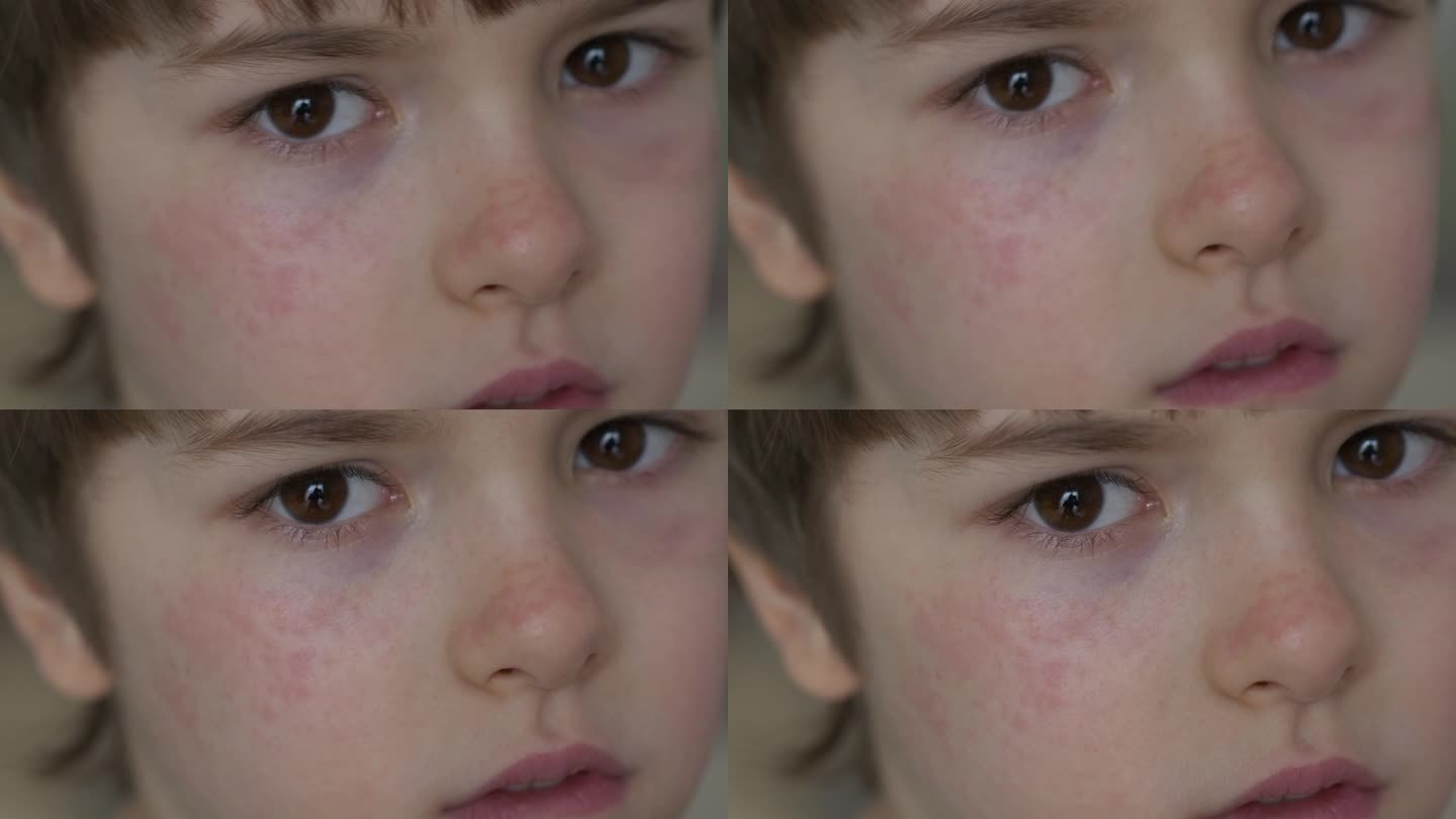 男孩皮肤干红，还抓挠脸。儿童抓伤特应性皮肤。儿童身体和面部的皮炎、素质低下、过敏。刺激和瘙痒。男孩皮