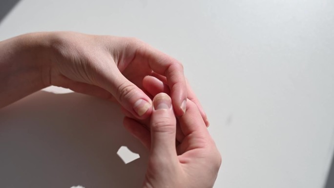 患有指甲疾病的手——骨髓炎，白色背景。美甲后甲板与甲床的分离