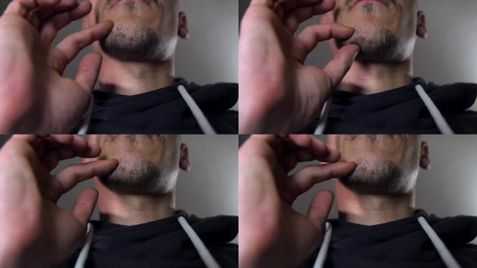 一个男人用手揉着下巴上的痘痘(特写)。