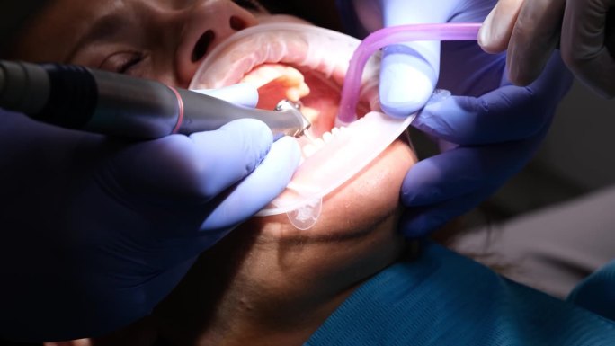 牙医用牙钻准备牙齿，以便安装牙贴面和牙冠