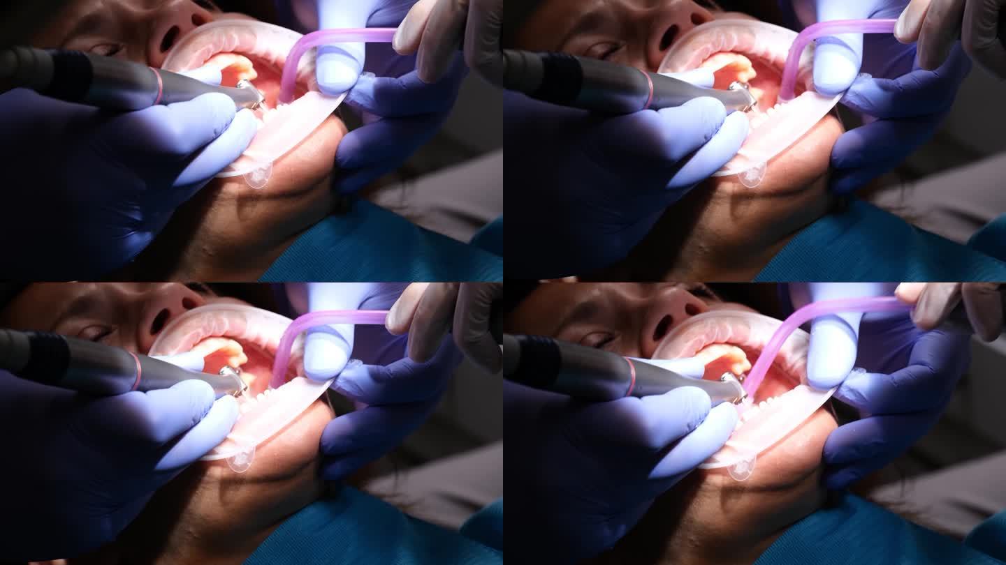 牙医用牙钻准备牙齿，以便安装牙贴面和牙冠