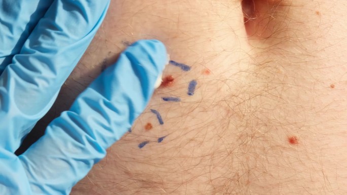 皮肤科医生在男性胎记上涂抹护肤霜。检查良性痣。皮肤癌手术的介绍。医生检查皮赘