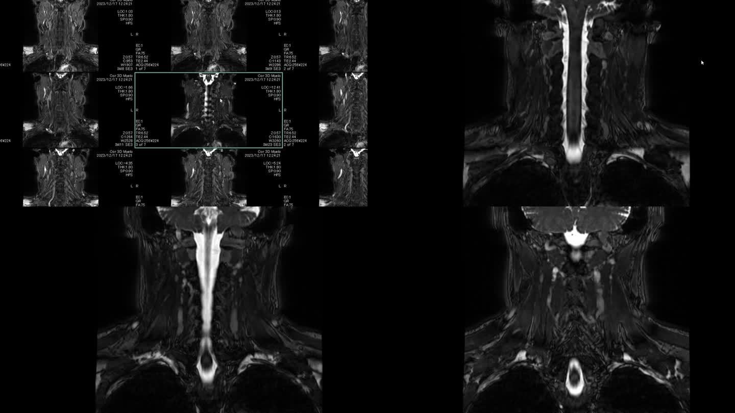 磁共振成像(MRI)