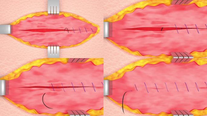 三维手术缝合cg动画