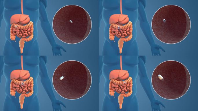 胶囊内窥镜手术的医学概念