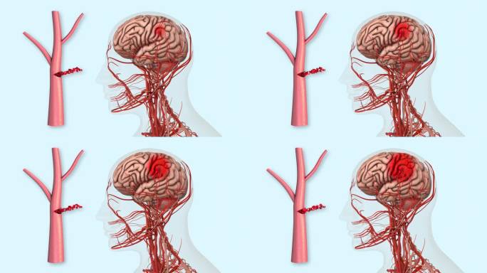 出血性中风对大脑的影响