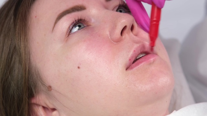 美容师在病人的嘴唇上进行麻醉，在注射透明质酸之前进行麻醉。在注射之前，要涂上一层麻醉药膏。