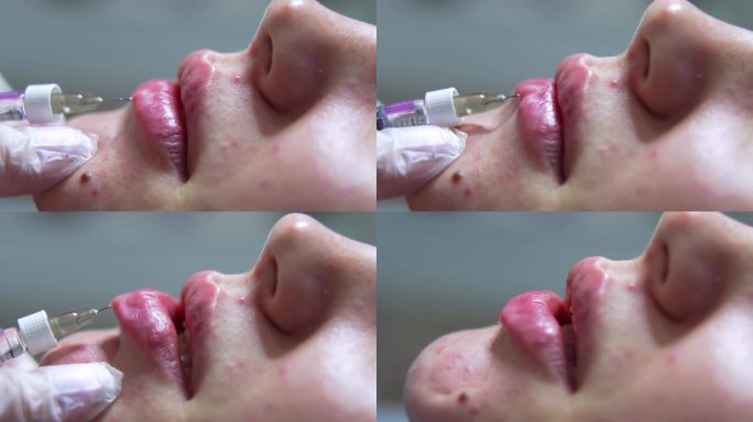 美容师医生在年轻漂亮的女人的嘴唇上注射肉毒杆菌。极致的近距离4k拍摄
