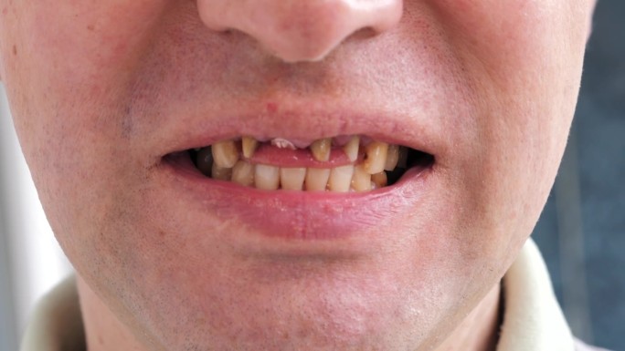 牙周病，牙齿松动，在无牙的人的口腔，关闭。病人的牙齿问题及正畸治疗