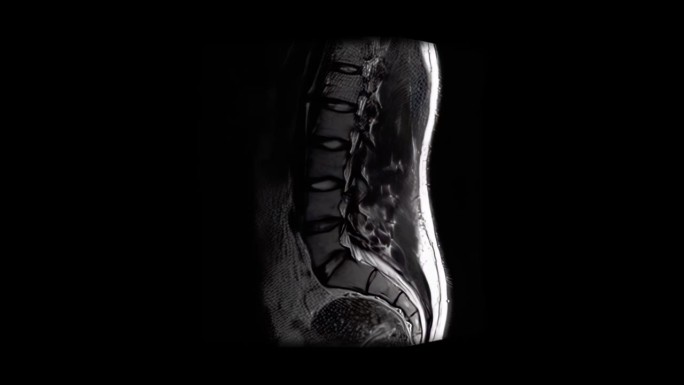 MRI扫描男性腰椎显示轻度椎间盘突出，从一侧到一侧扫描