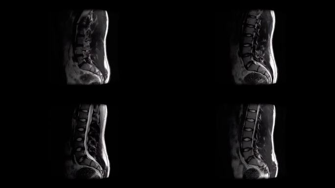 MRI扫描男性腰椎显示轻度椎间盘突出，从一侧到一侧扫描