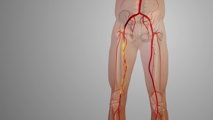外周动脉搭桥手术医学动画