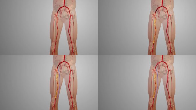 外周动脉搭桥手术医学动画