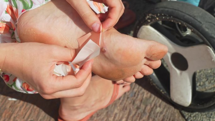 女人给脚上的水泡敷膏药，硬旅行的概念。海绵状血管瘤。