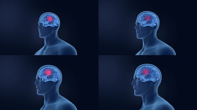 大脑结构脑健康 头痛偏头痛