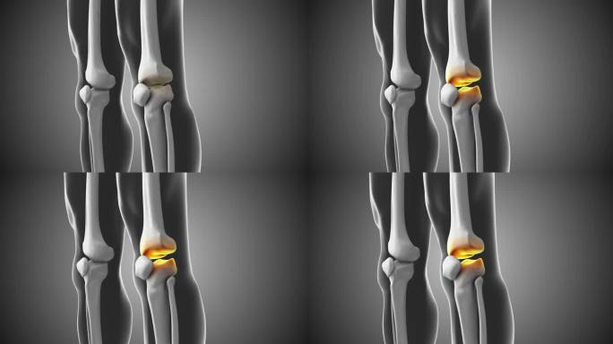 膝关节疼痛与间隙医学动画