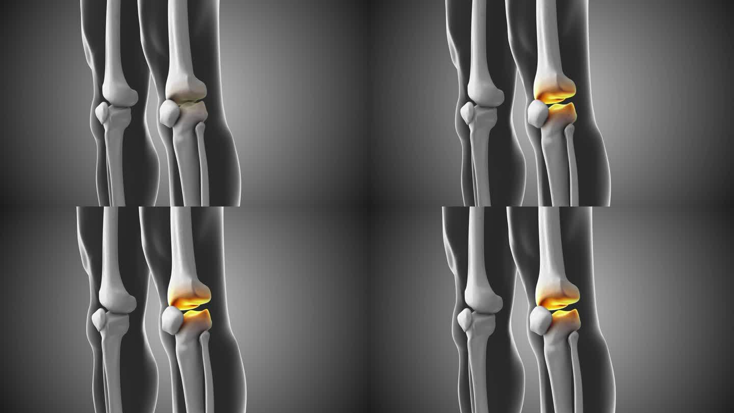 膝关节疼痛与间隙医学动画
