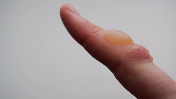 手指上有热烧伤，白色背景上有水泡。烧伤治疗概念，烧伤程度，特写。文本复制空间