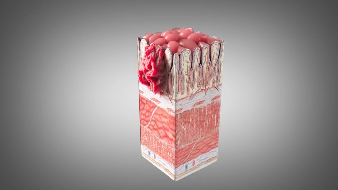 胃黏膜肿瘤生长过程动画