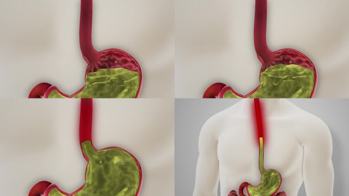 胃酸反流GERD疾病3D动画