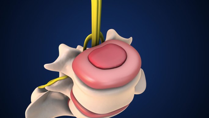 腰椎椎间盘突出症的医学动画分析