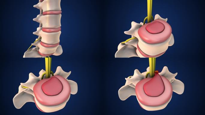 腰椎椎间盘突出症的医学动画分析