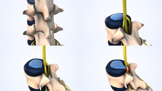 腰椎椎间盘突出症医学动画